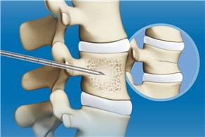 【脊柱】椎體成形術(shù)輔助器械(PVP)